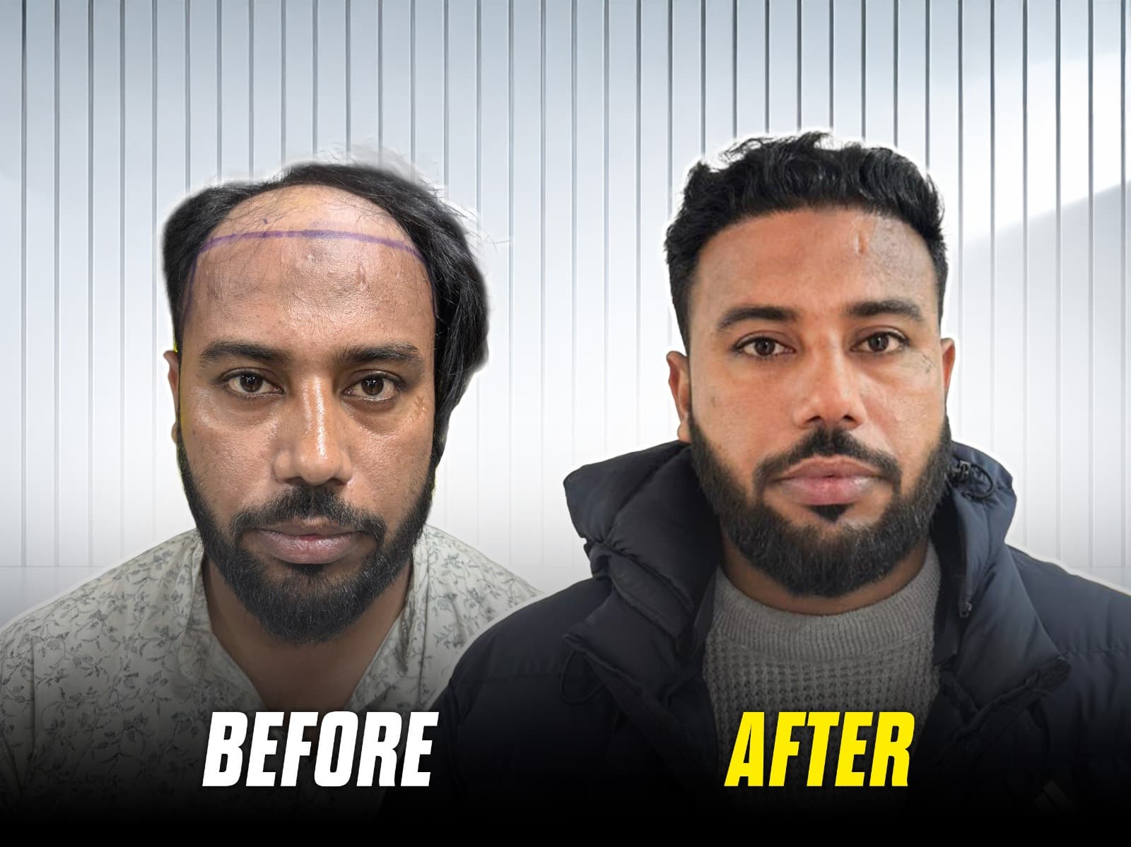 Abhishek’s remarkable hair transplant transformation.